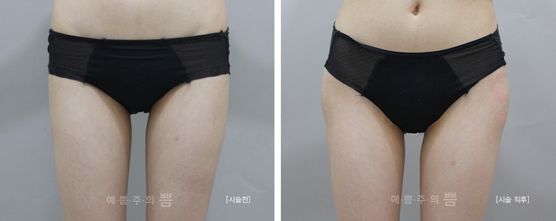글로벌 명동점_골반필러